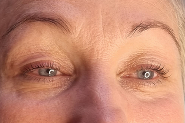 Finsk nervbanemassage